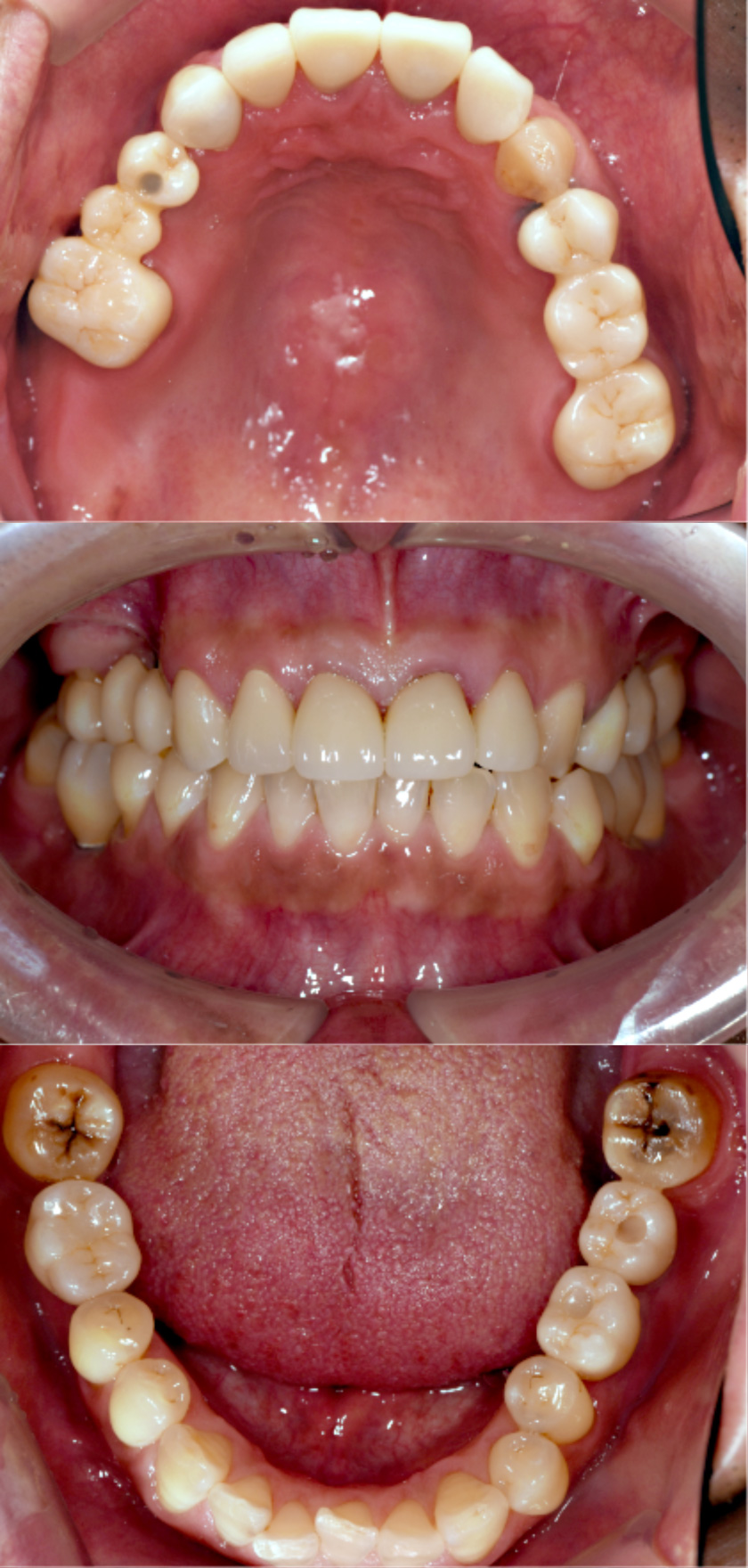 全顎治療（歯周外科・インプラント）　術後